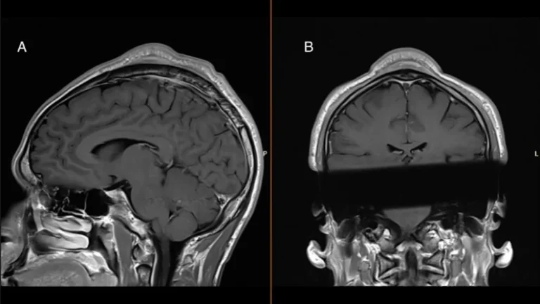 ‘Headspin hole’: Man develops scalp tumor after decades of breakdancing