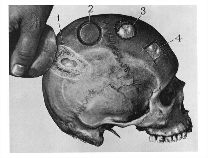 Surgery , Trepanation